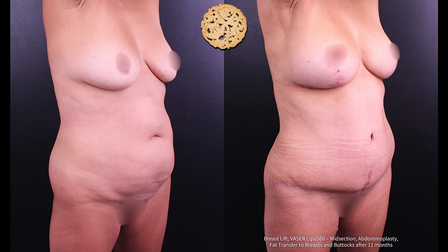 Liposuction Before & After