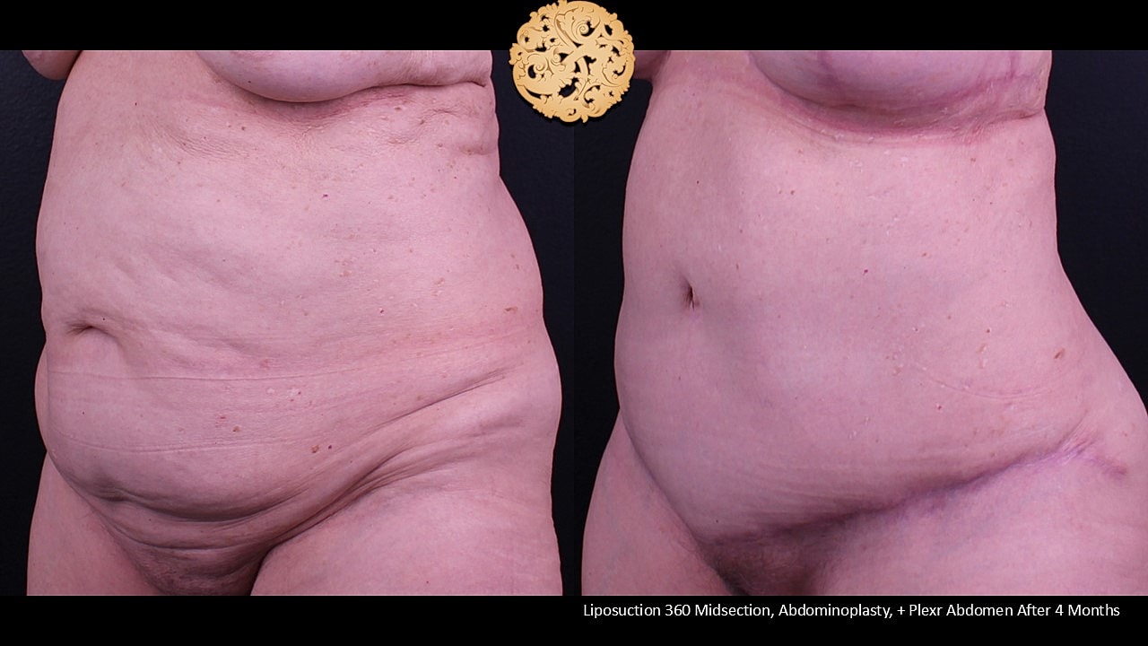 Liposuction Before & After
