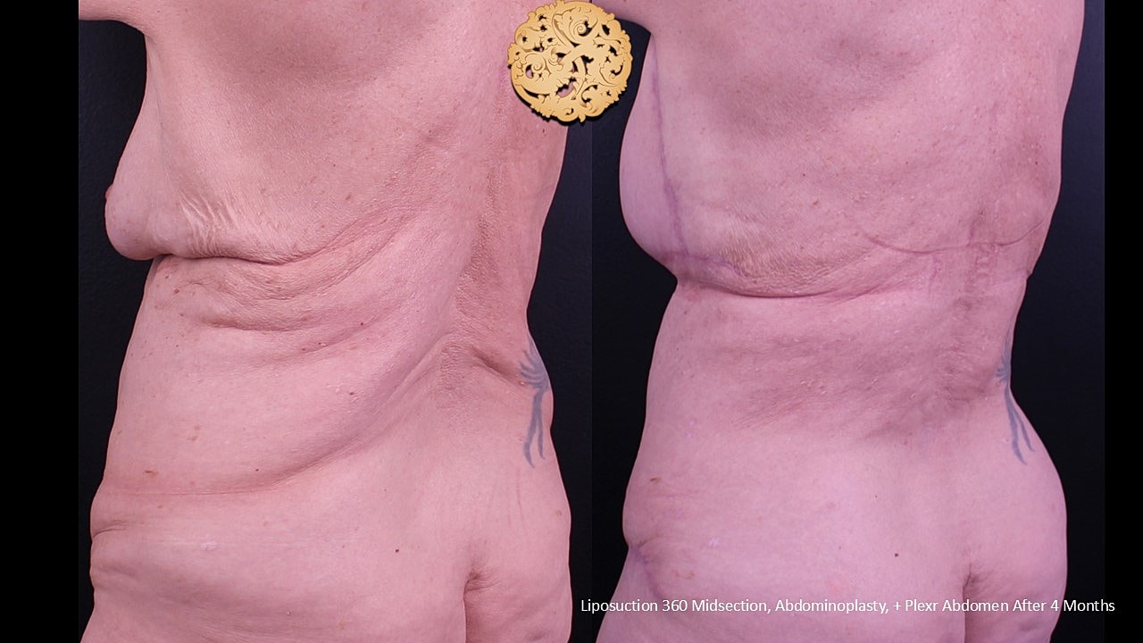 Liposuction Before & After