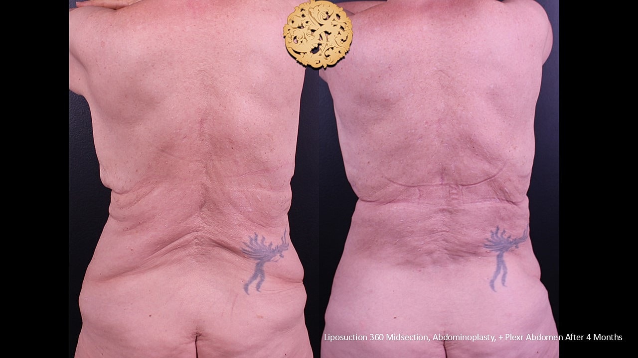 Liposuction Before & After