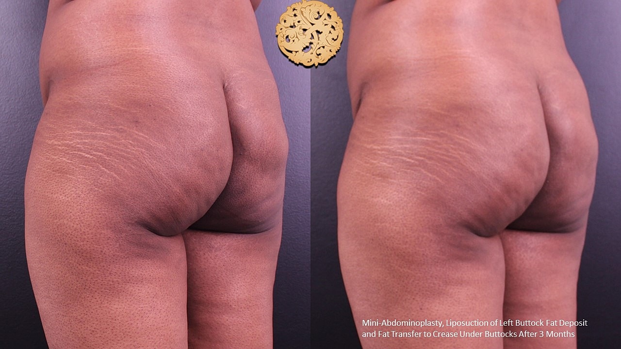 Liposuction Before & After