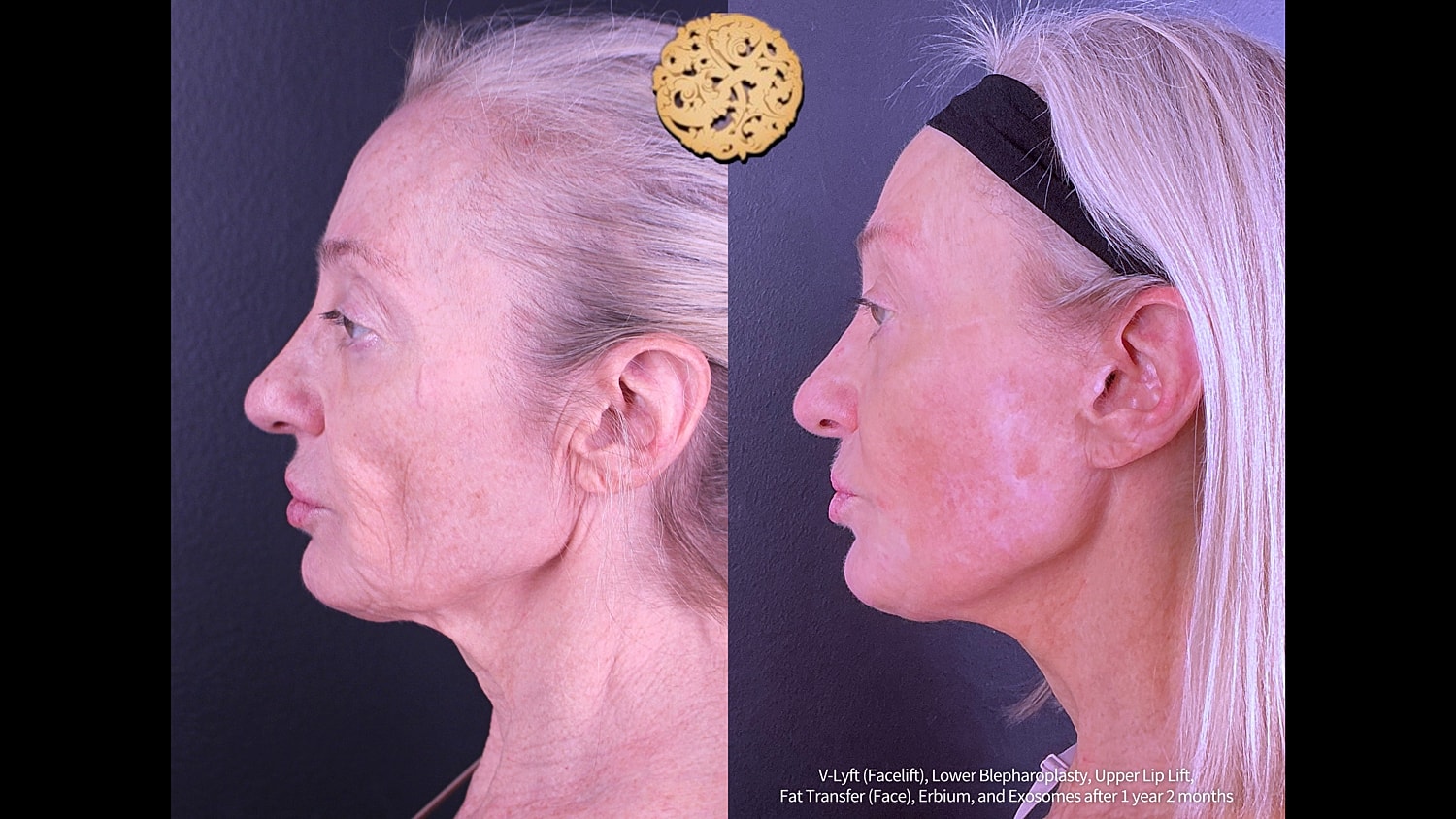  Before & After