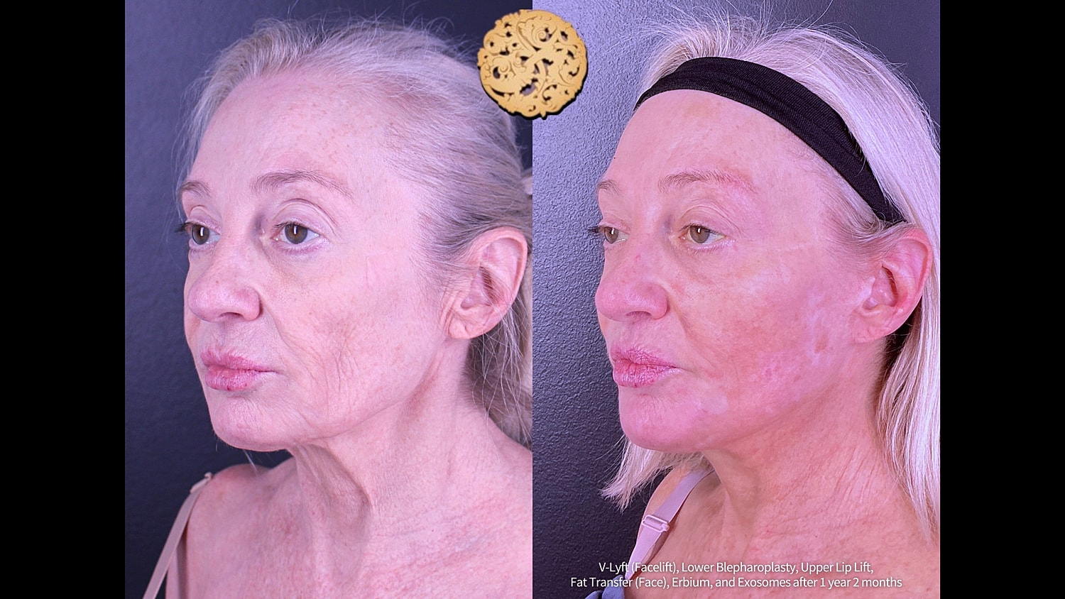  Before & After