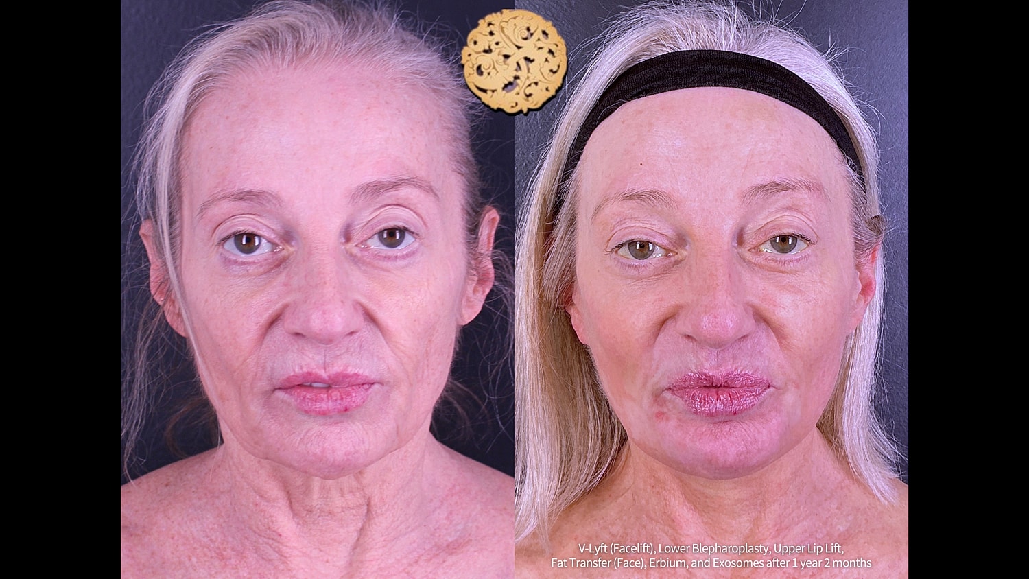  Before & After