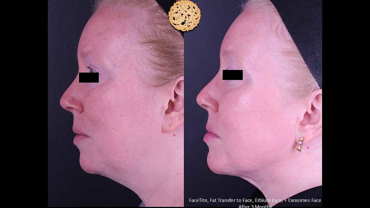 Before and after facial treatments comparison.