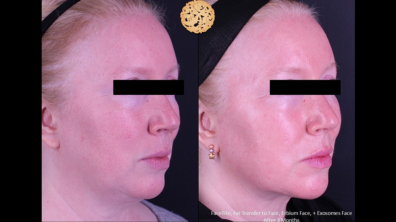 Before and after facial treatment results.