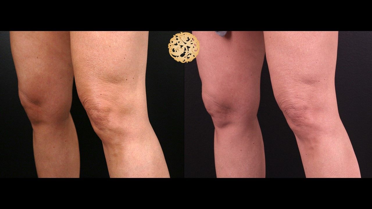 Morpheus8 Knees Before & After