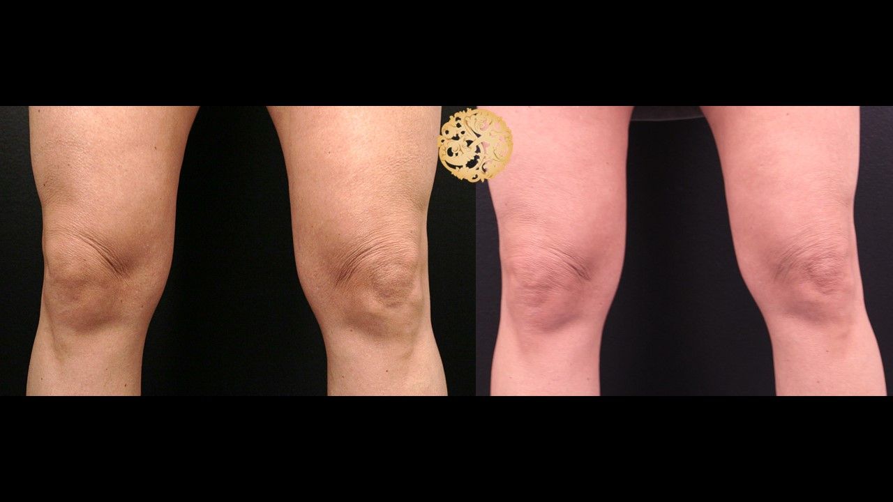 Morpheus8 Knees Before & After