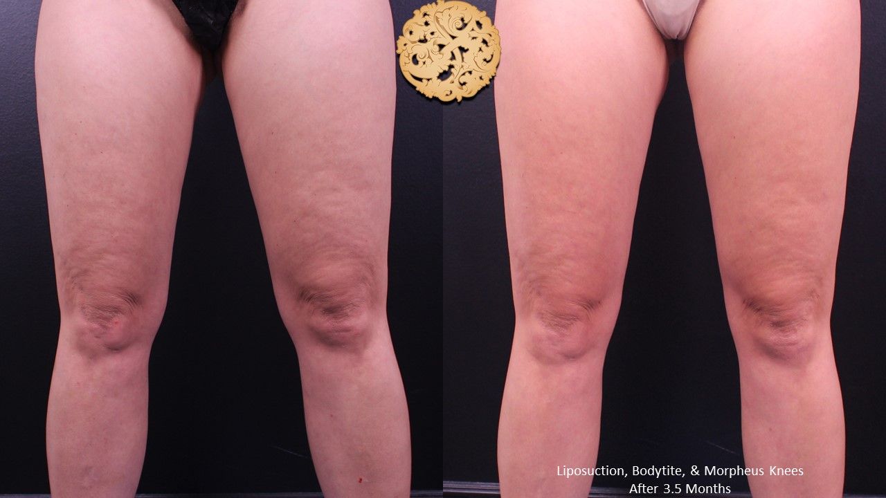 Morpheus8 Knees Before & After
