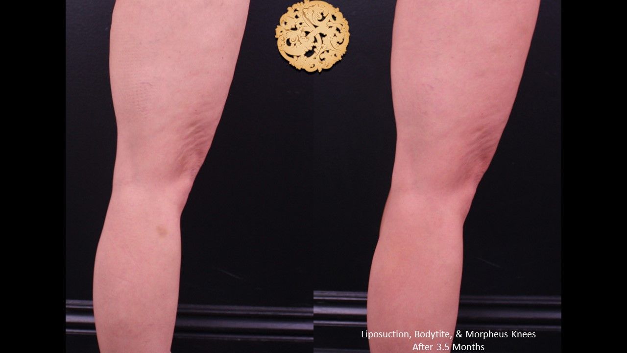 Morpheus8 Knees Before & After