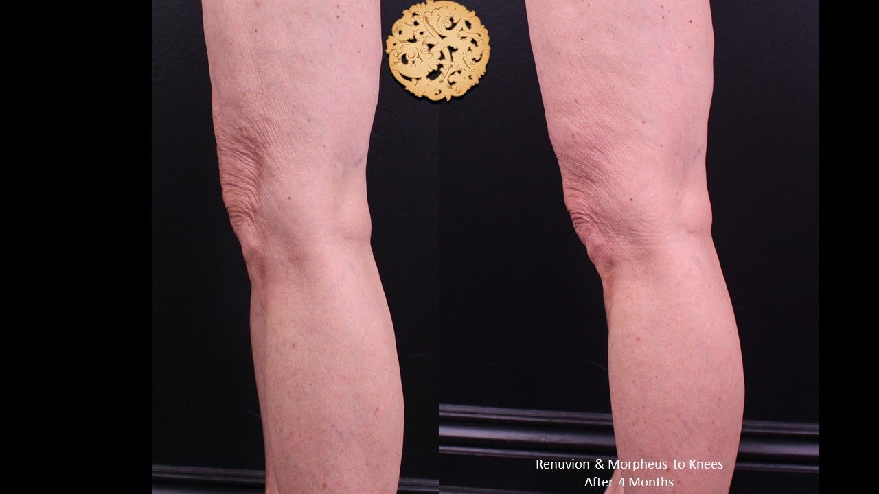 Morpheus8 Knees Before & After