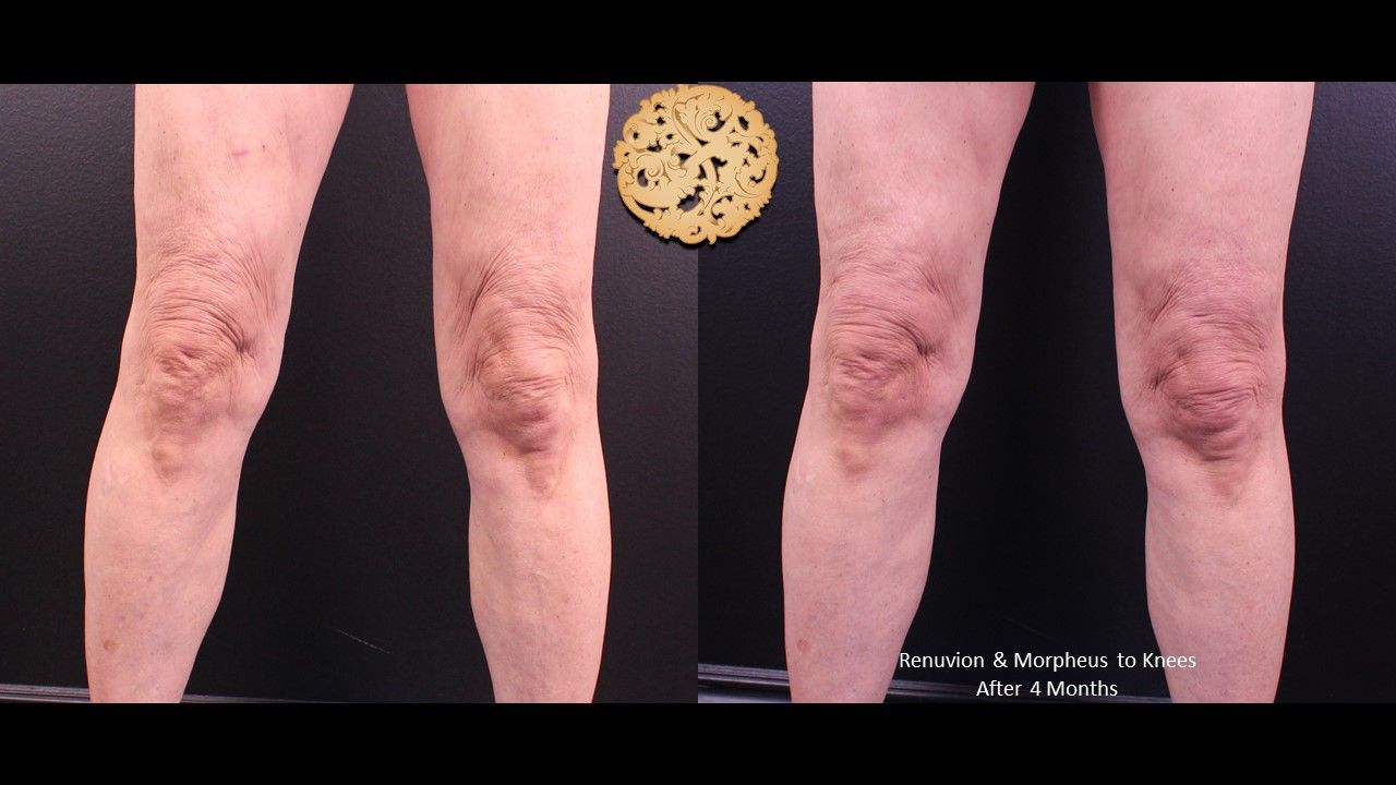 Morpheus8 Knees Before & After