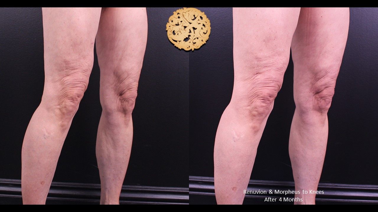 Morpheus8 Knees Before & After
