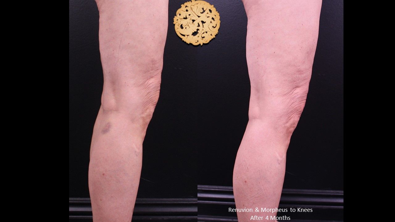 Morpheus8 Knees Before & After