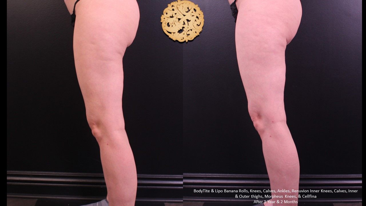 Morpheus8 Knees Before & After
