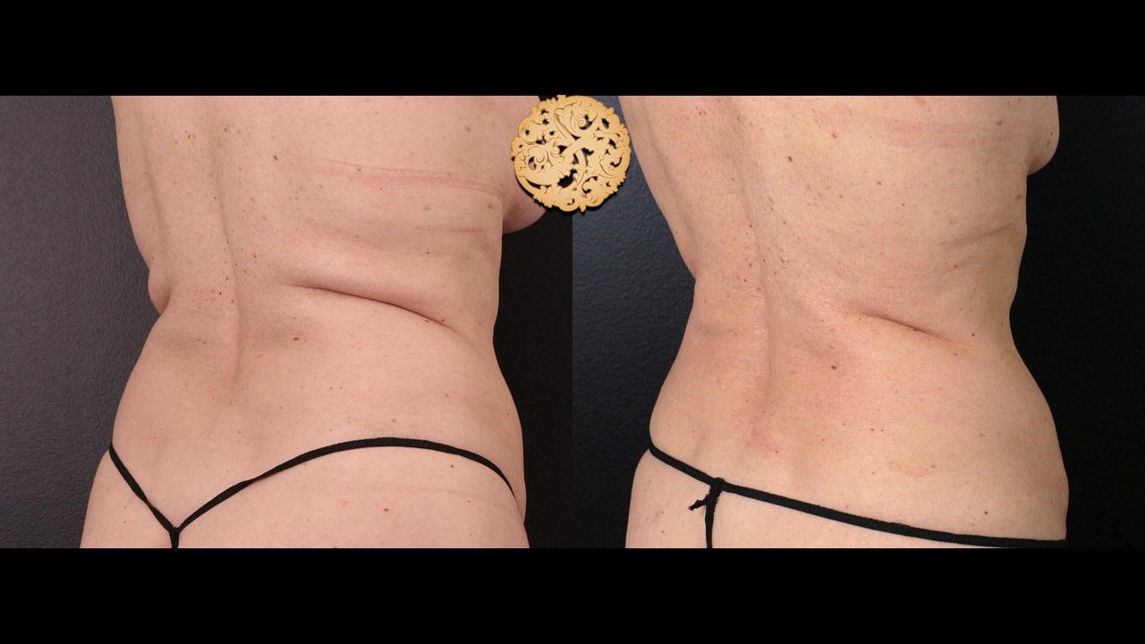 Back Coolsculpting Before & After
