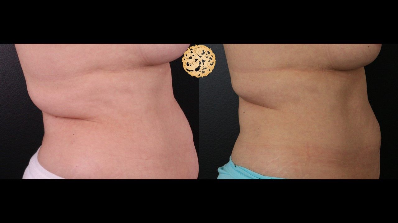 Back Coolsculpting Before & After