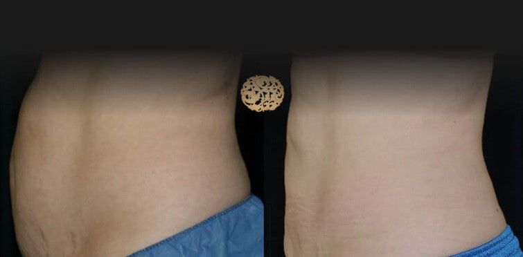 Back Coolsculpting Before & After