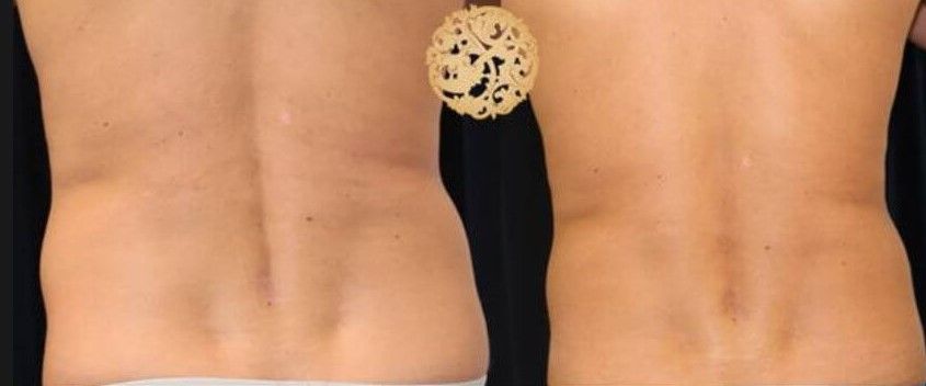 Back Coolsculpting Before & After