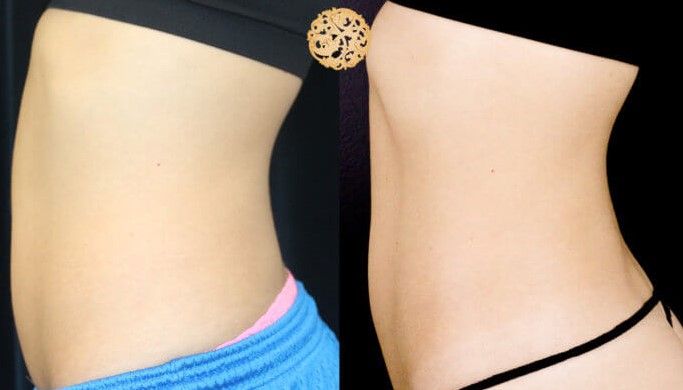 Back Coolsculpting Before & After