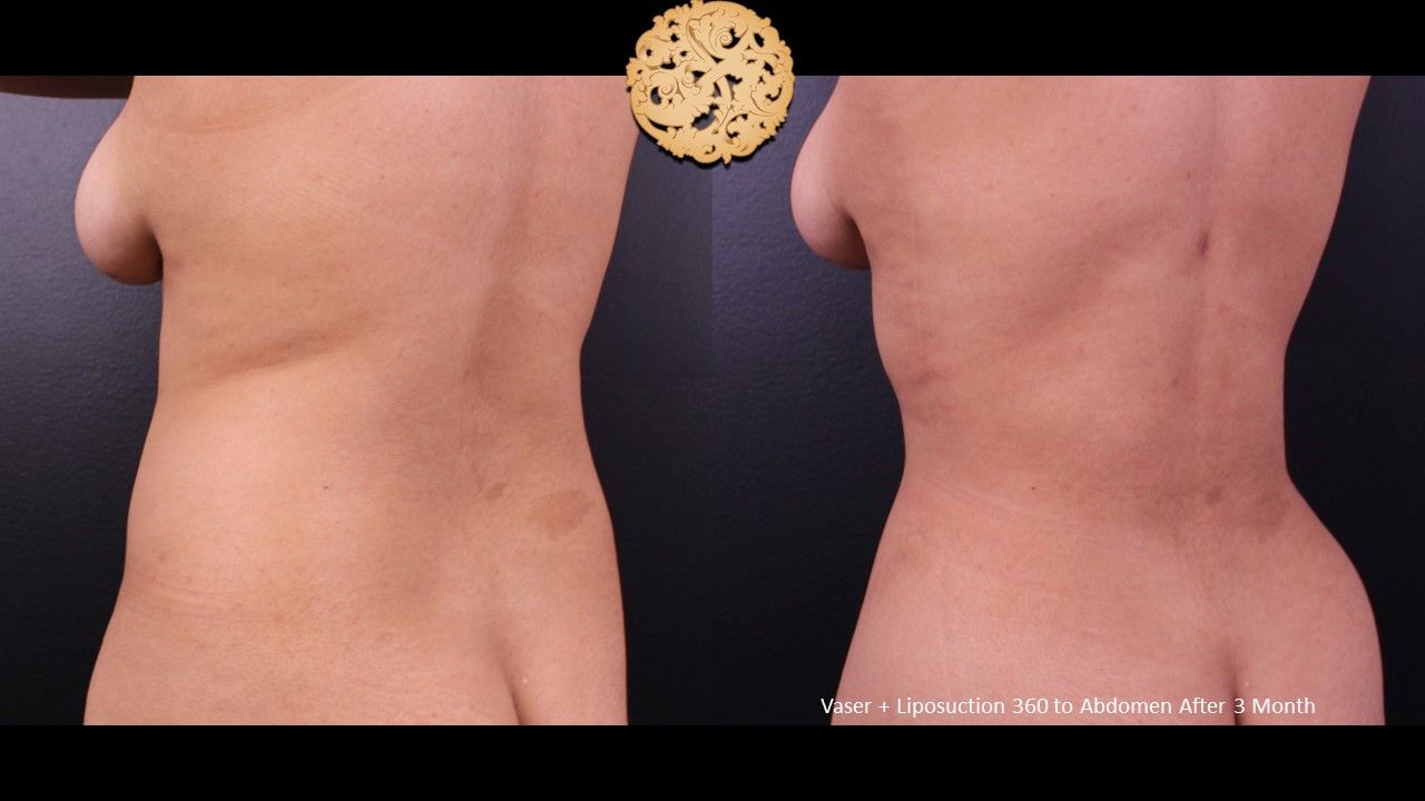 Liposuction Trunk Before & After