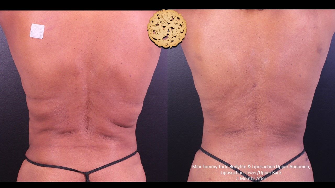 Liposuction Trunk Before & After