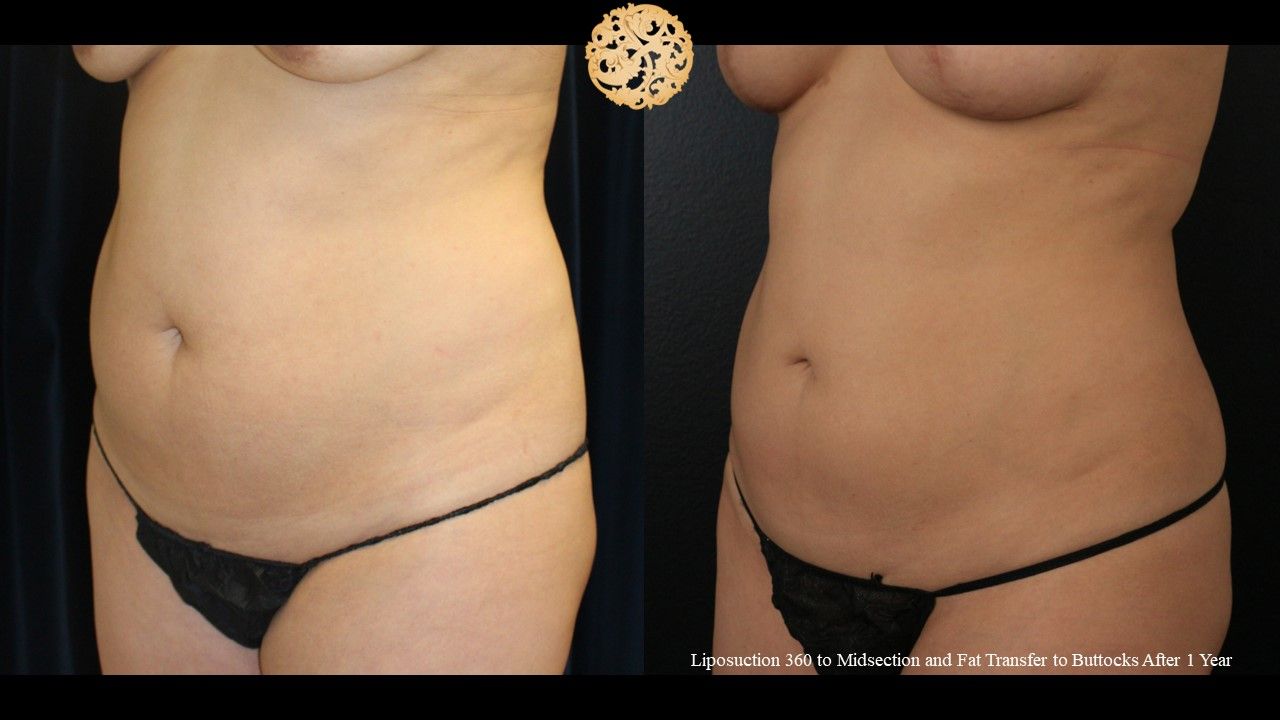 Liposuction Trunk Before & After