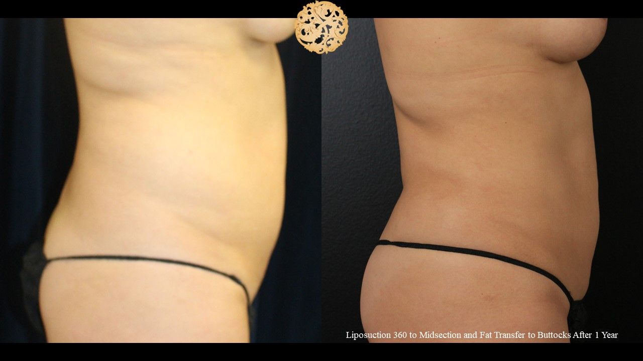 Liposuction Trunk Before & After