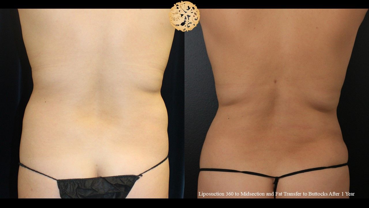Liposuction Trunk Before & After