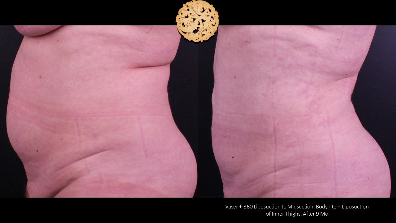 Liposuction Trunk Before & After