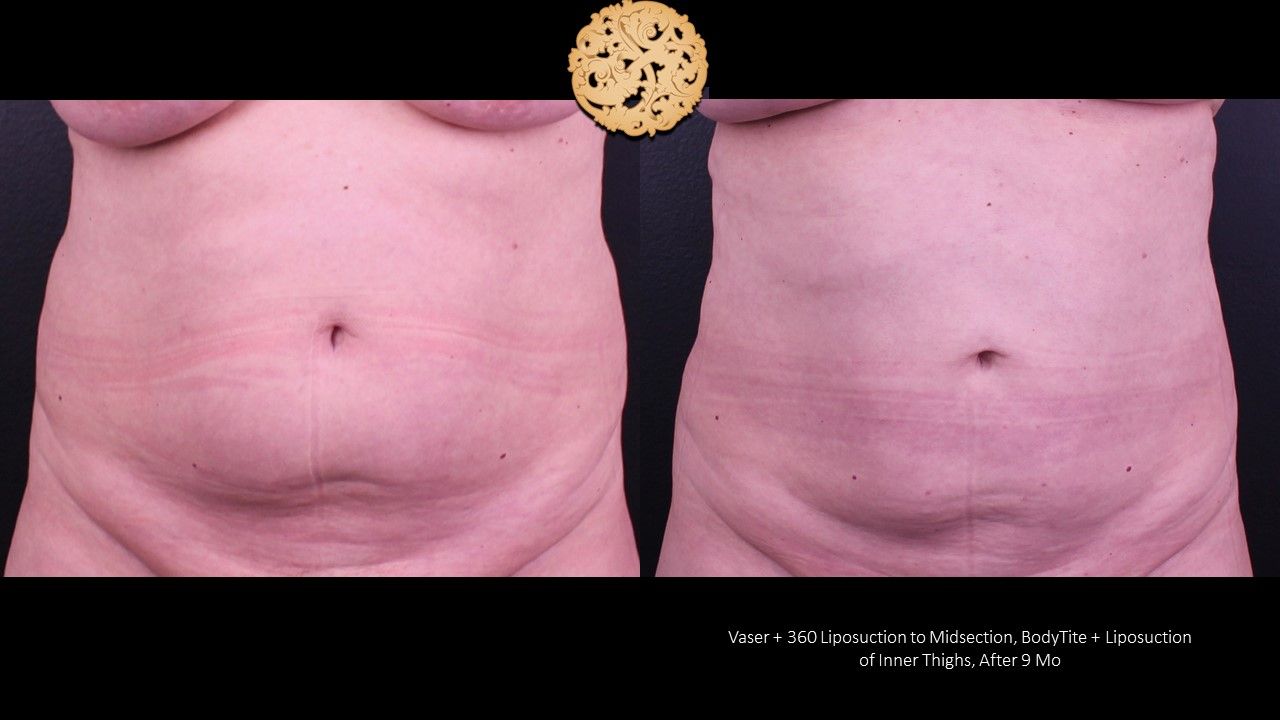 Liposuction Trunk Before & After