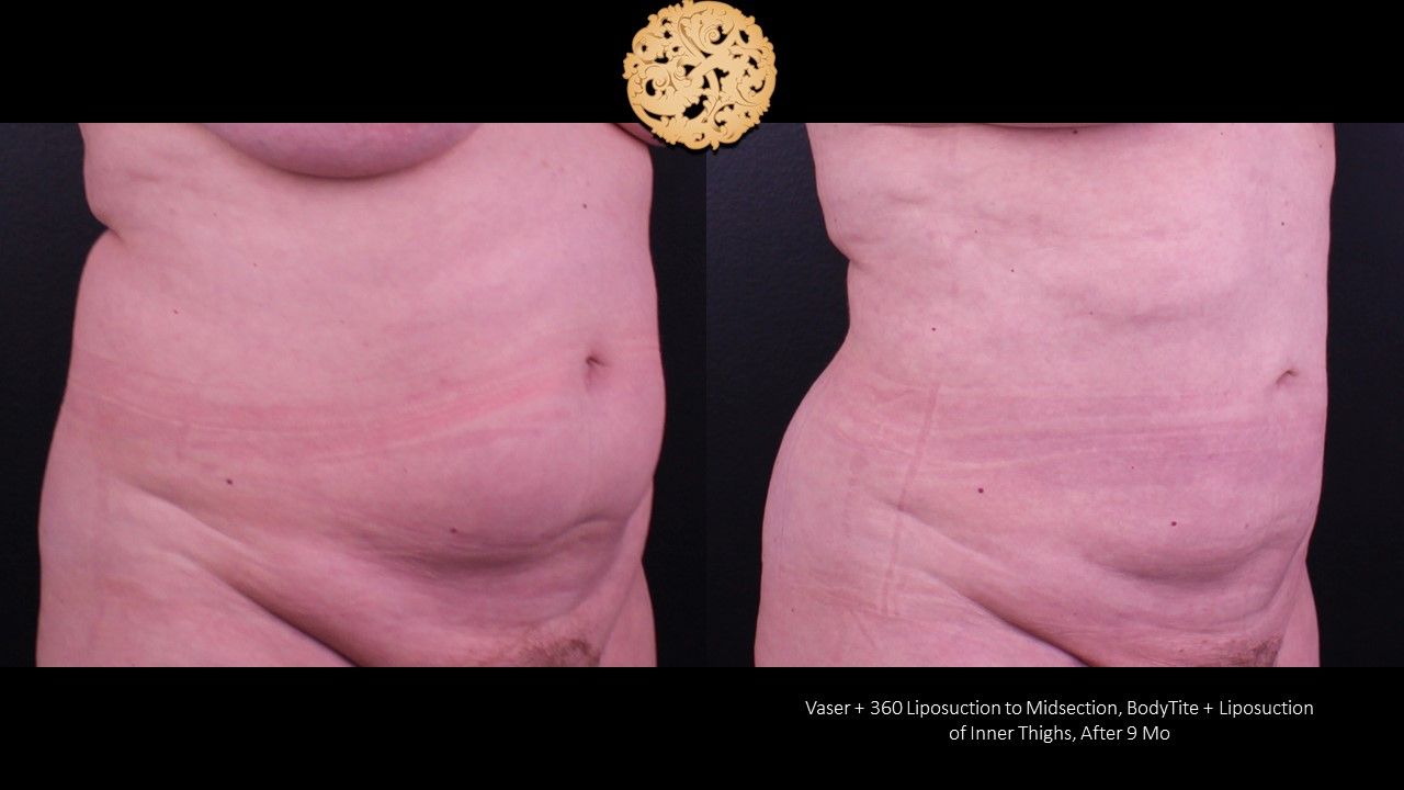 Liposuction Trunk Before & After