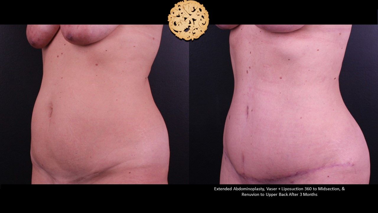 Liposuction Trunk Before & After