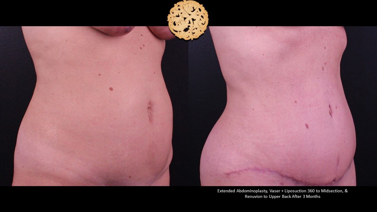 Liposuction Trunk Before & After