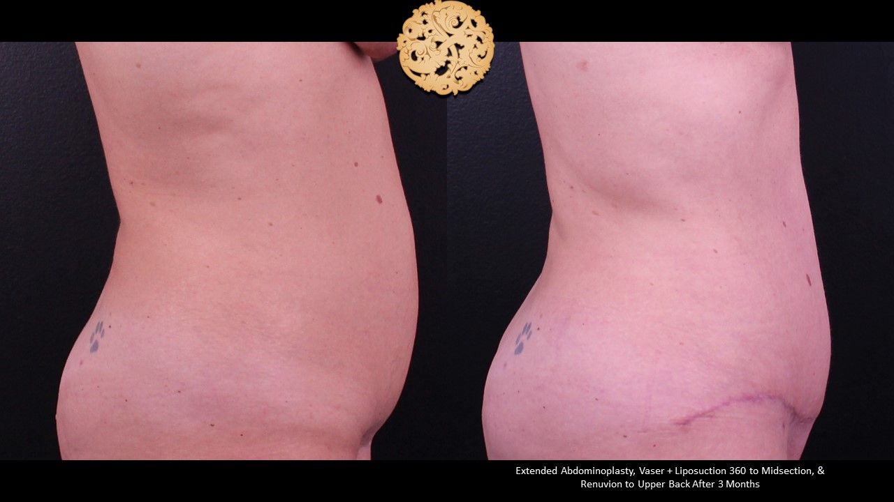 Liposuction Trunk Before & After