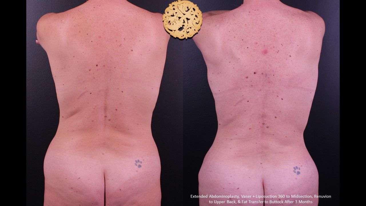 Liposuction Trunk Before & After