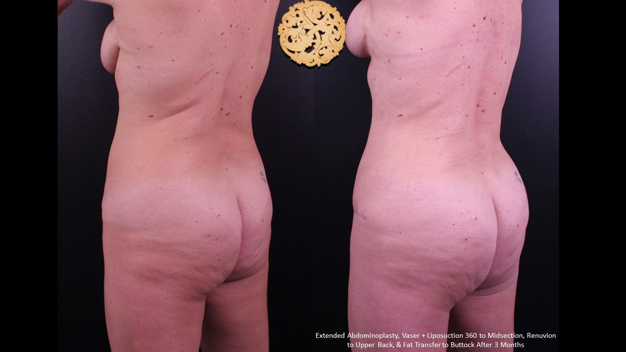 Liposuction Trunk Before & After