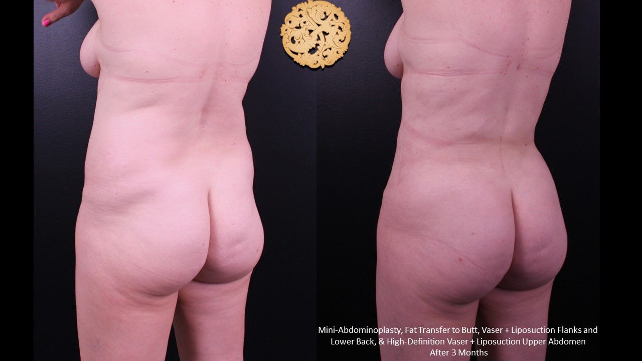 Liposuction Trunk Before & After