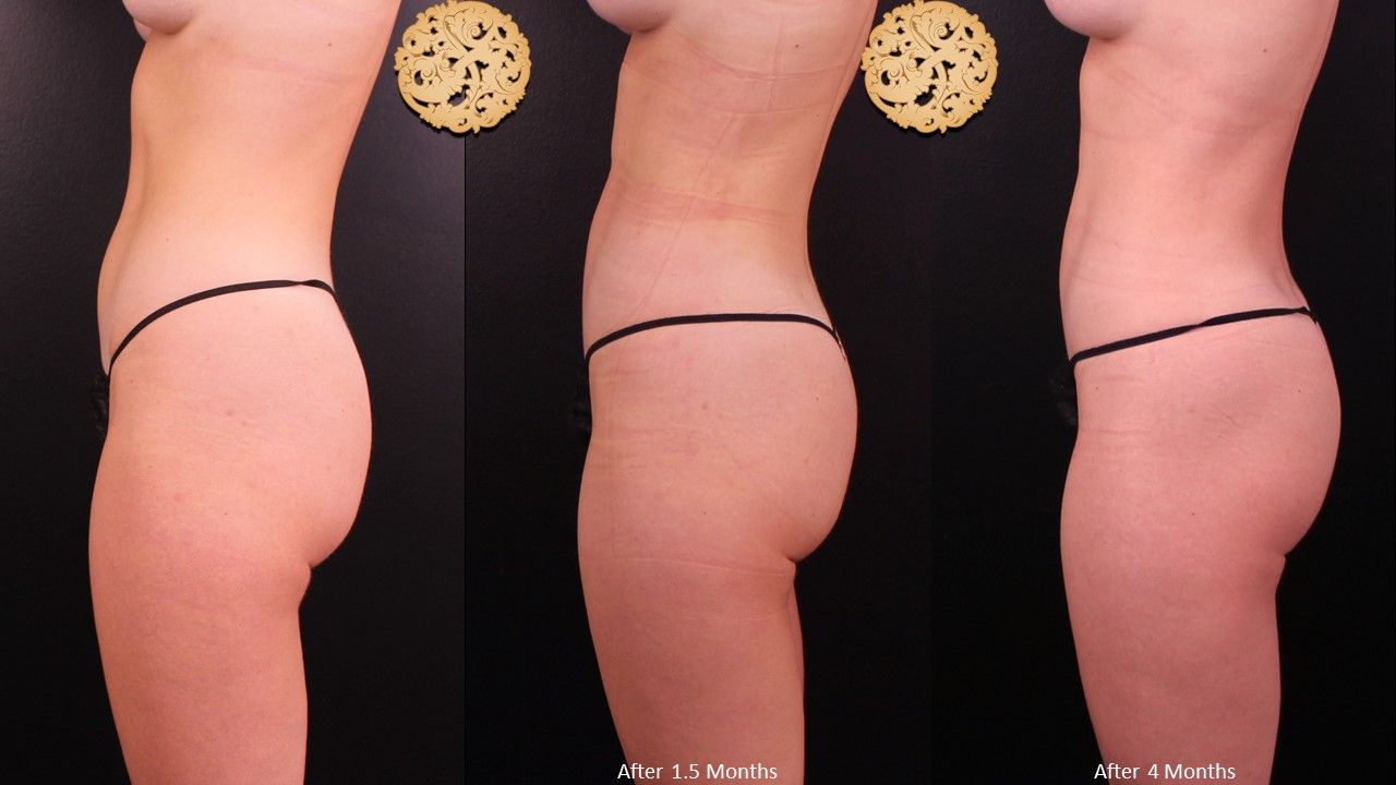 Liposuction Trunk Before & After