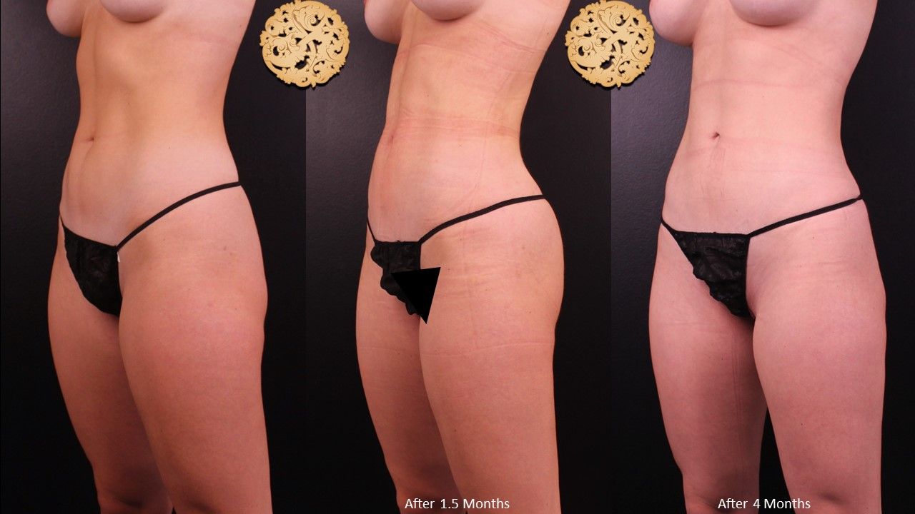 Liposuction Trunk Before & After
