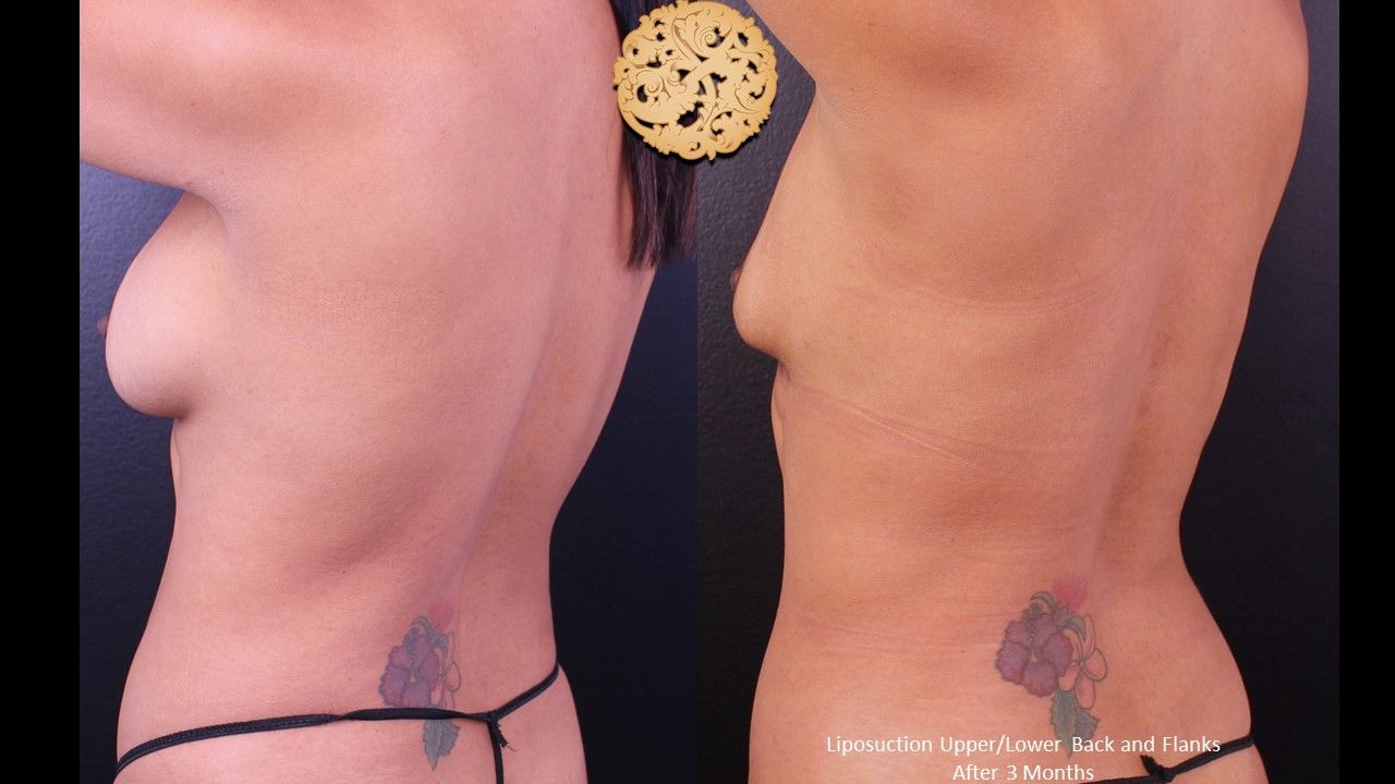 Liposuction Trunk Before & After