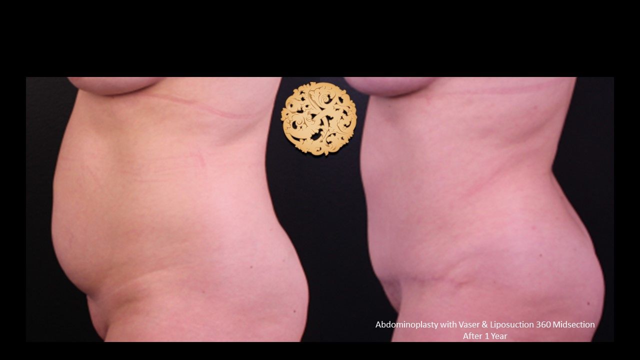 Liposuction Trunk Before & After