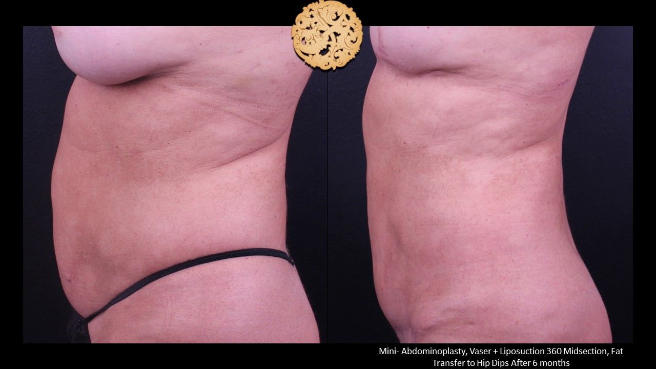 Liposuction Trunk Before & After
