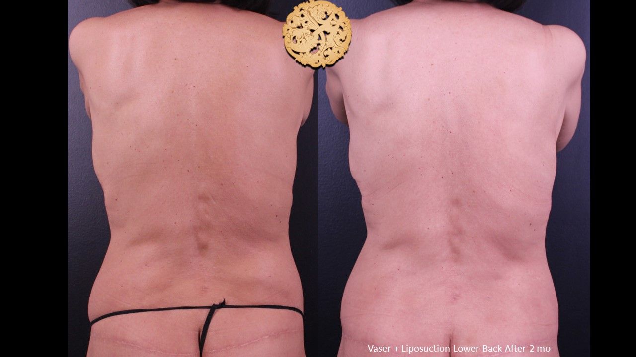 Liposuction Trunk Before & After