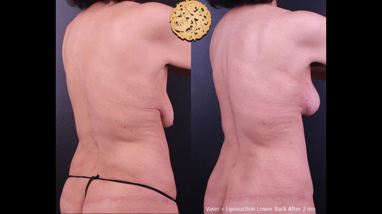 Liposuction Trunk Before & After