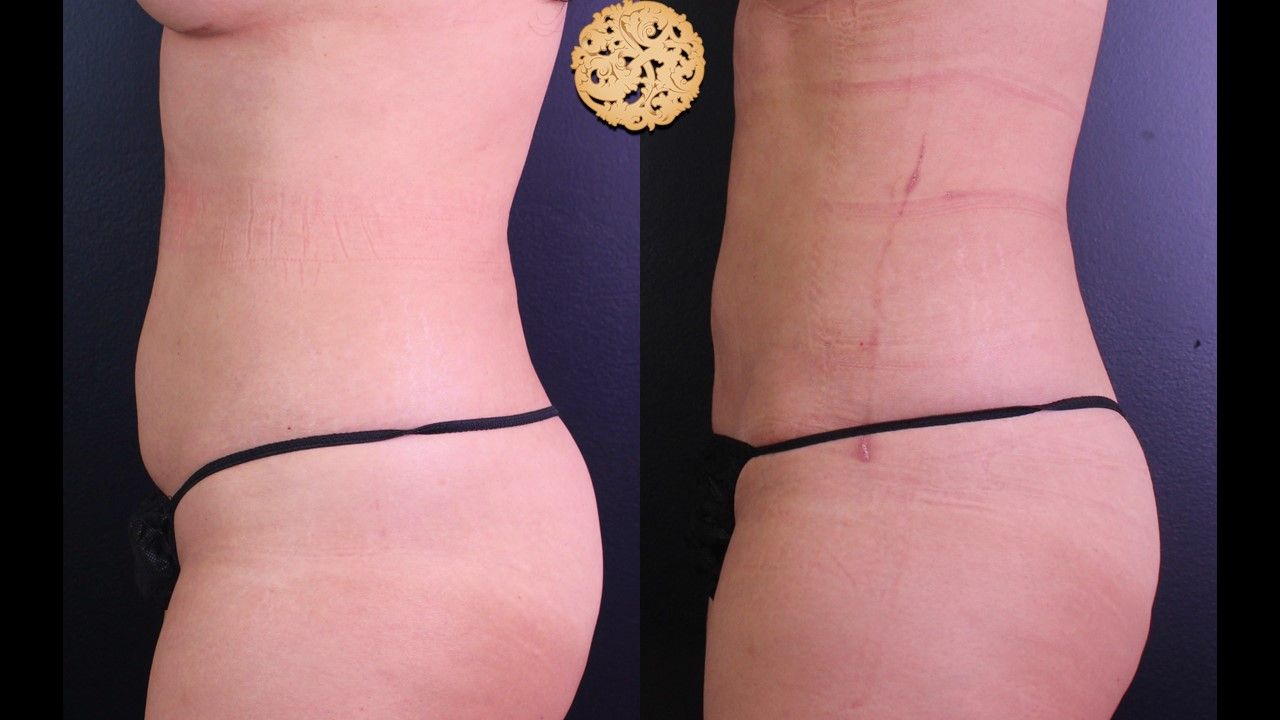 Liposuction Trunk Before & After