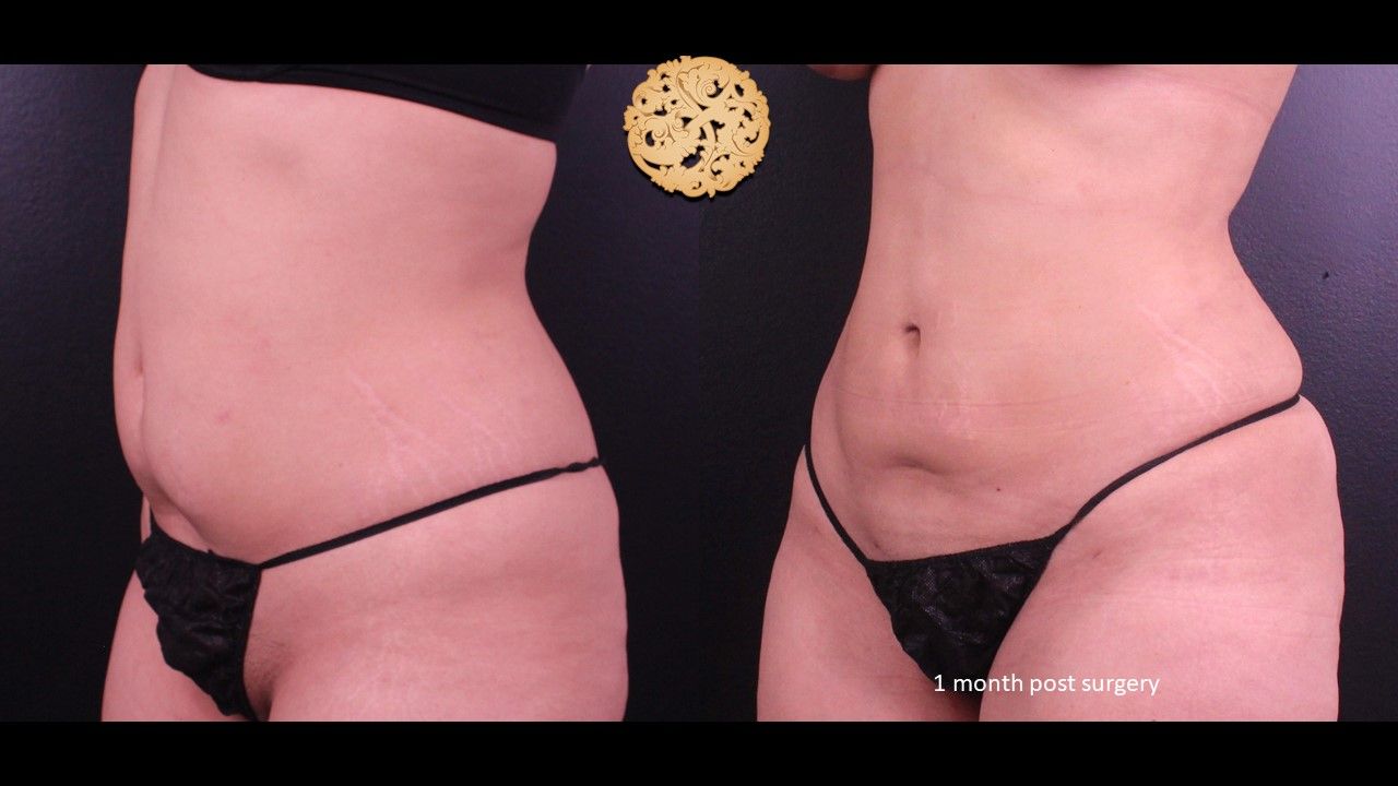 Liposuction Trunk Before & After