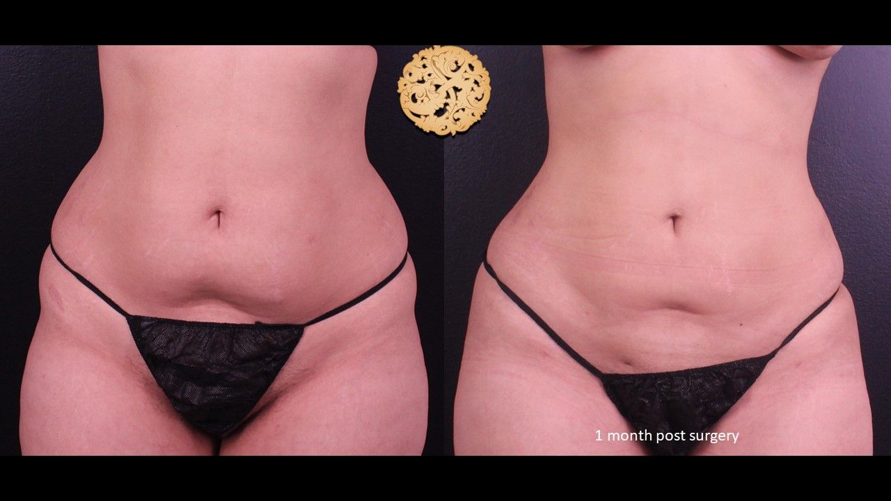 Liposuction Trunk Before & After