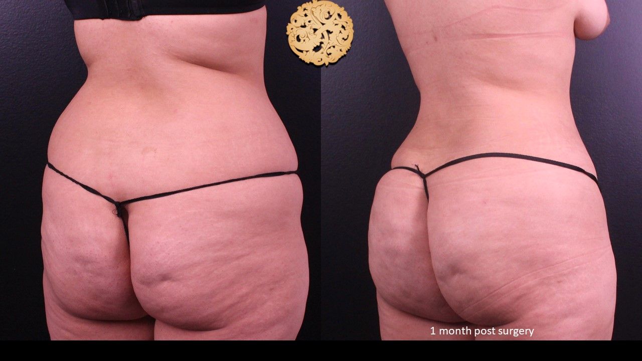 Liposuction Trunk Before & After