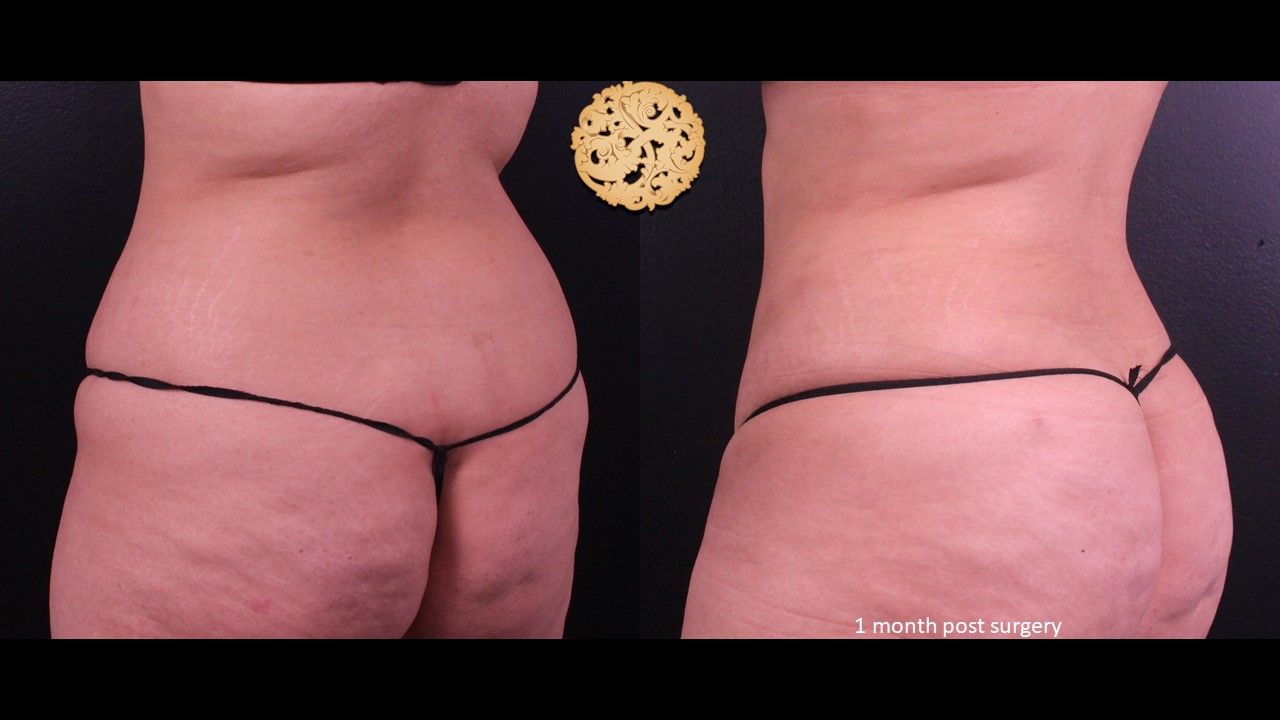 Liposuction Trunk Before & After